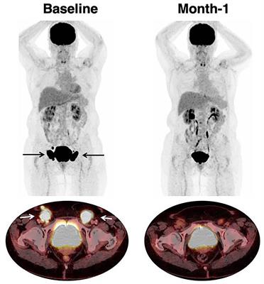 Current and Future Role of Medical Imaging in Guiding the Management of Patients With Relapsed and Refractory Non-Hodgkin Lymphoma Treated With CAR T-Cell Therapy